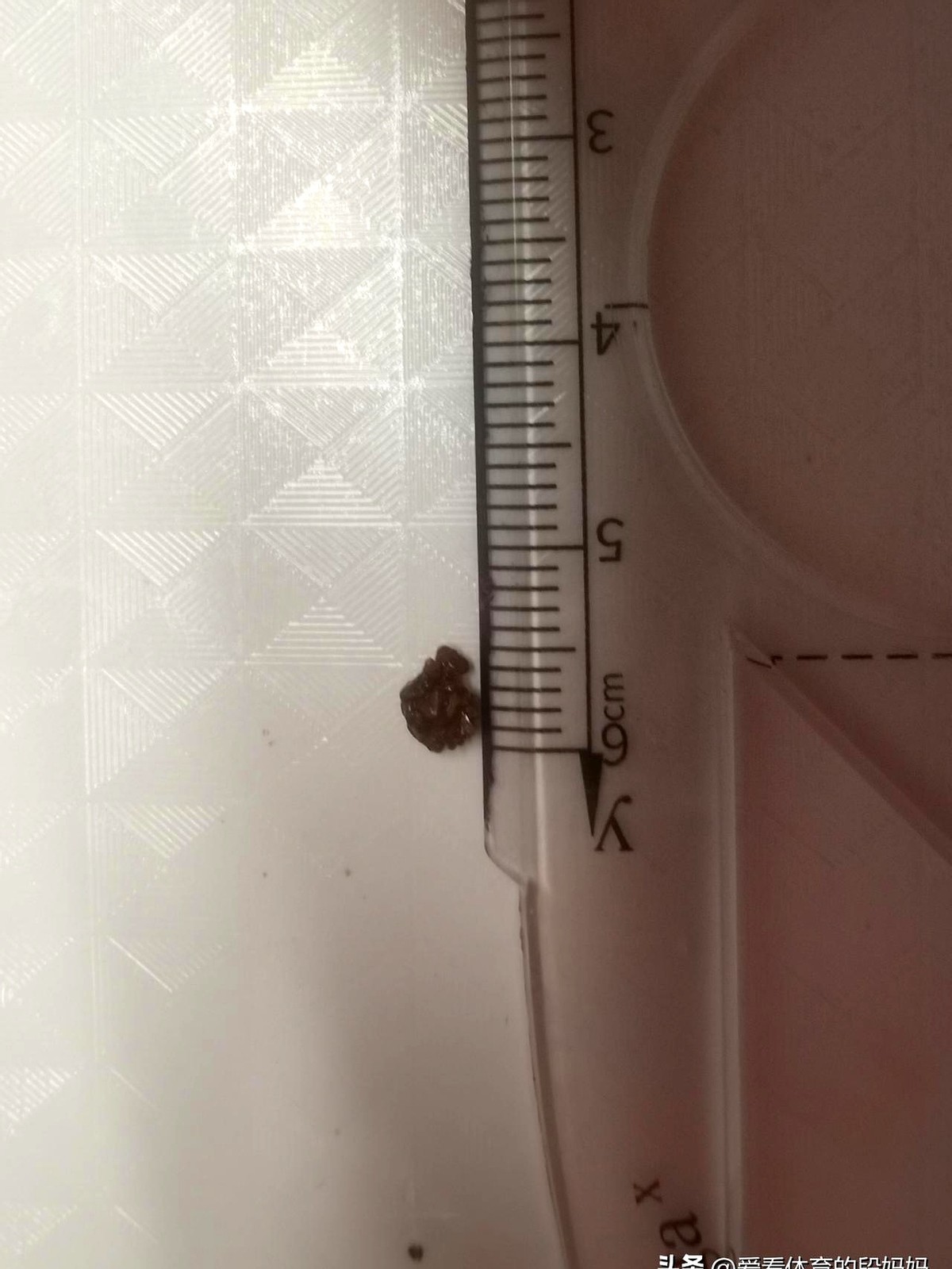 小U助手：肾结石患者的自述，痛苦与饮水的重要性，如何有效预防复发？