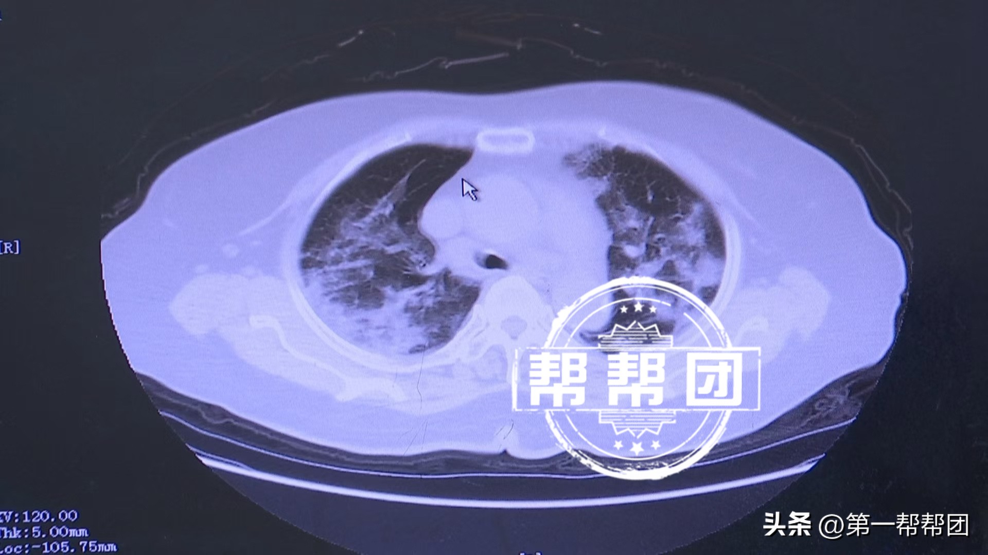 易单助手下载官网：新冠病毒再次活跃，医生教你缓解咽痛的有效方法与注意事项